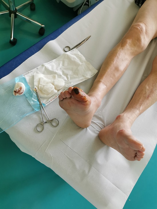 Če je napotitev na diagnostiko žil opravljena, lahko razmišljamo tudi o lokalni odstranitvi mrtve kože na stopalu.
